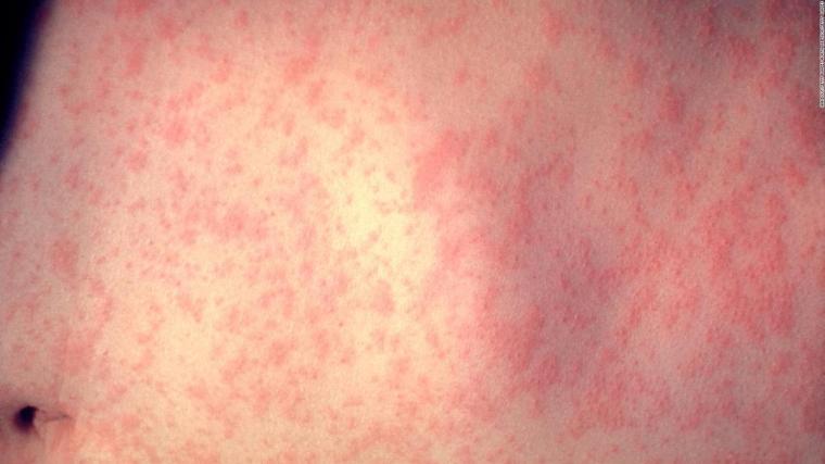 190410160827-encuentro-sarampion-brote-full-169